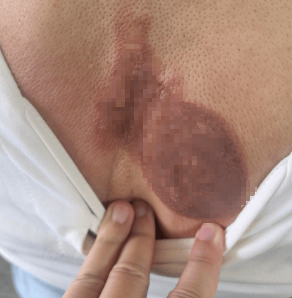 廣西一女子去美容院做專案，結果卻被燙成二度燙傷！背部留下兩處疤痕！