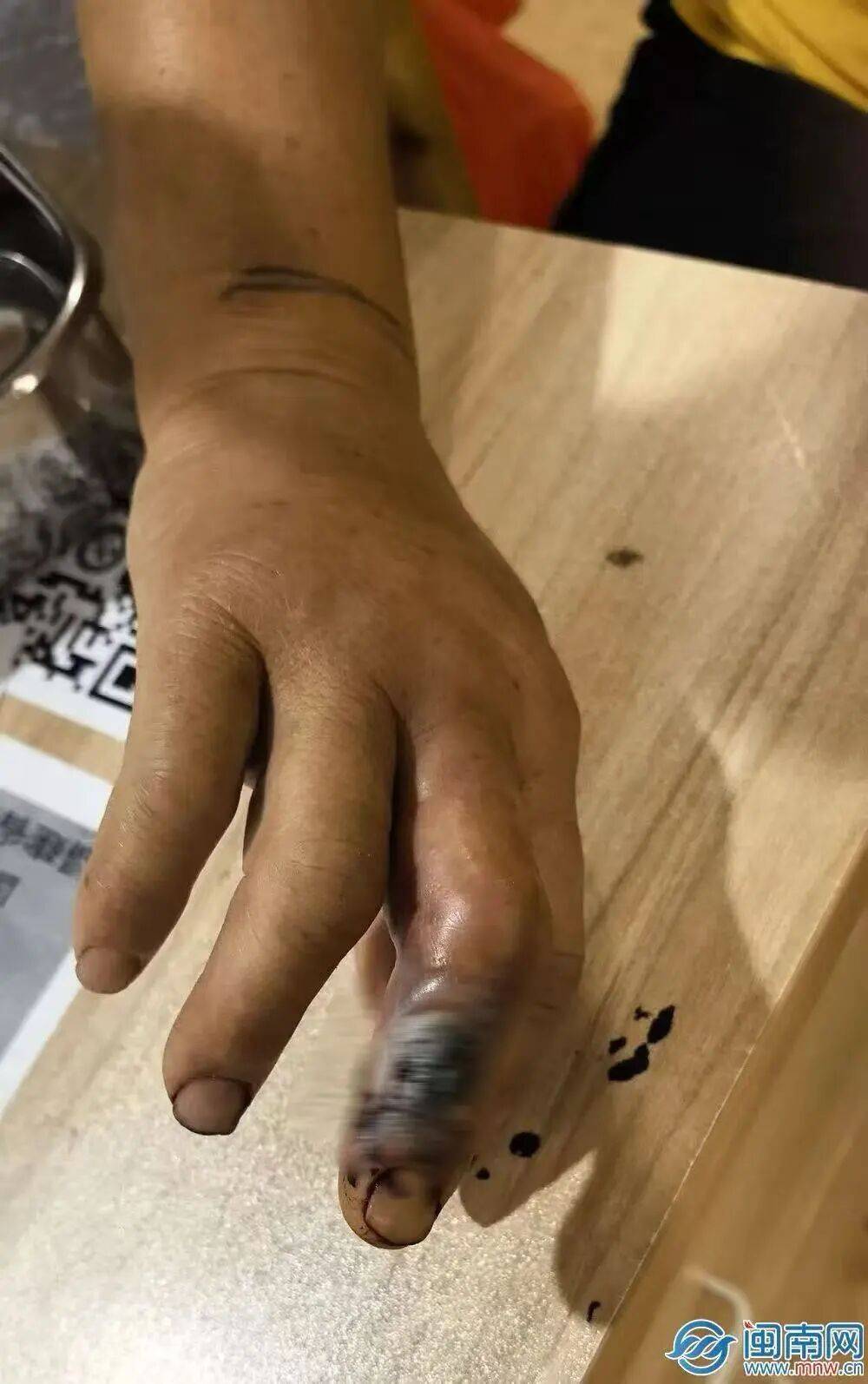 驚險自救！53歲阿姨被眼鏡蛇咬傷，徒手活捉2米毒蛇帶到醫院……