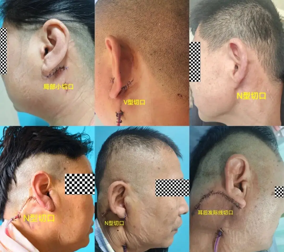 隱痕除瘤！31例美容切口腮腺手術，療效和顏值雙線上